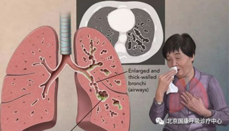 北京呼吸专家姚宏胤解读：支气管扩张能不能治愈