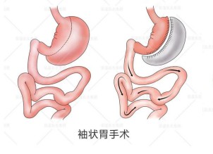怎么减肥才科学?原来我们都进入了误区,缩胃手术是这样做的